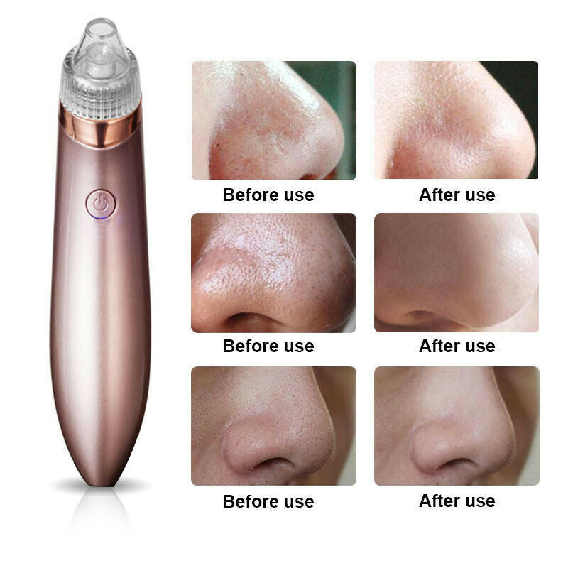 Blackhead Remover Vacuum